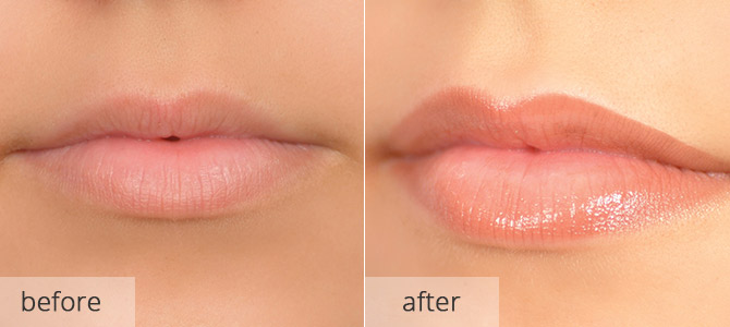 cosmetic enhancements - lips 1