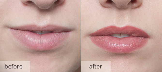 cosmetic enhancements - lips 2