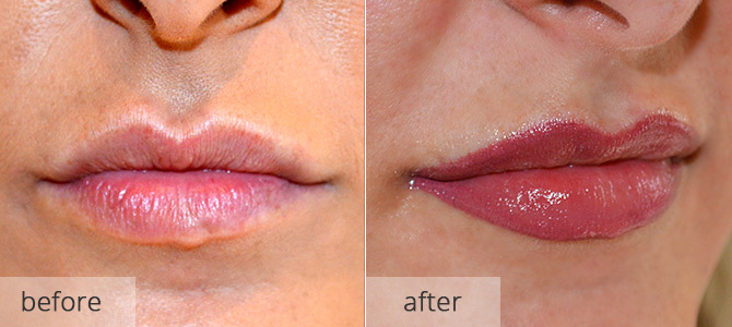cosmetic enhancements - lips 3