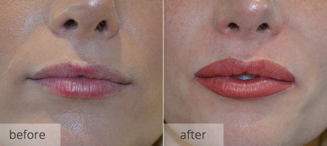 cosmetic enhancements - lips 4